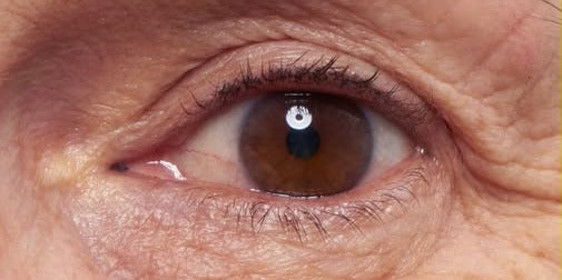 Before using Sensational Eyes: close-up of under-eye wrinkles and fine lines